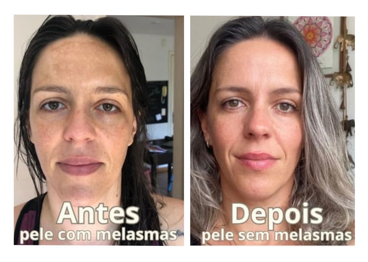 Antes e depois do cuidado com melasma